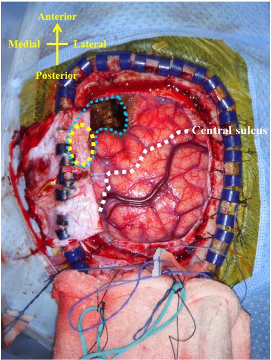 Functional hemispherotomy in Rasmussen syndrome in the absence of classic MRI findings