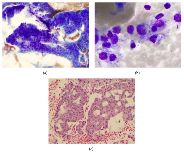 Utility of Immunohistochemistry and <i>ETV6</i> (12p13) Gene Rearrangement in Identifying Secretory Carcinoma of Salivary Gland among Previously Diagnosed Cases of Acinic Cell Carcinoma.