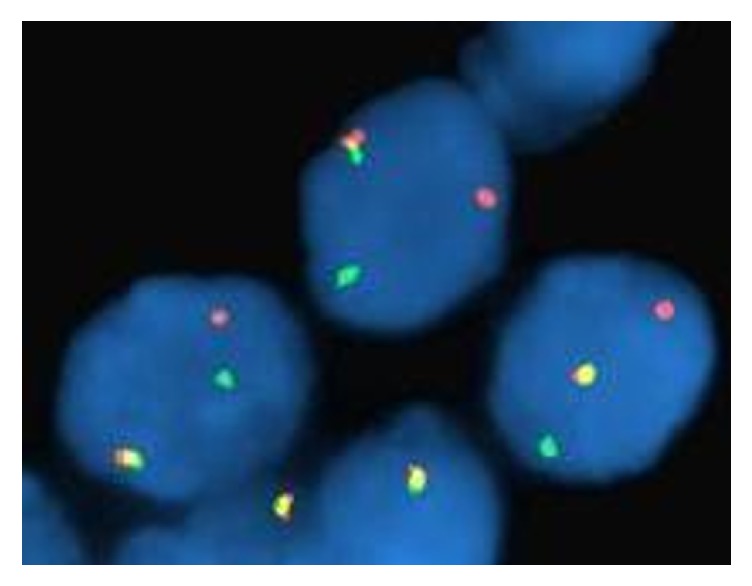 Utility of Immunohistochemistry and <i>ETV6</i> (12p13) Gene Rearrangement in Identifying Secretory Carcinoma of Salivary Gland among Previously Diagnosed Cases of Acinic Cell Carcinoma.