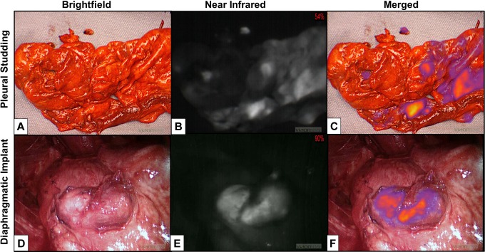 Near-Infrared Intraoperative Imaging Can Successfully Identify Malignant Pleural Mesothelioma After Neoadjuvant Chemotherapy.