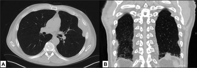 Near-Infrared Intraoperative Imaging Can Successfully Identify Malignant Pleural Mesothelioma After Neoadjuvant Chemotherapy.