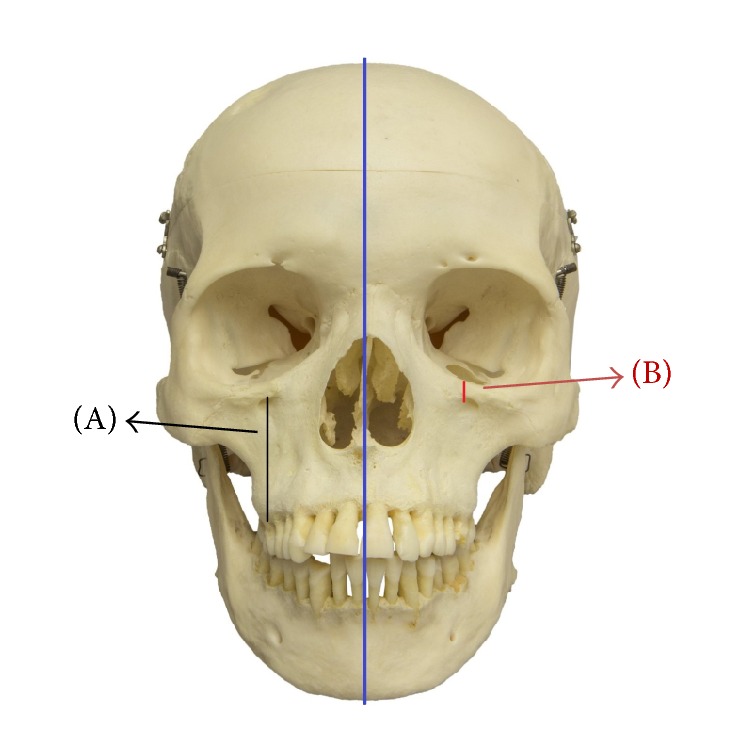 Infraorbital Foramen and Pterygopalatine Fossa Location in Dry Skulls: Anatomical Guidelines for Local Anesthesia.