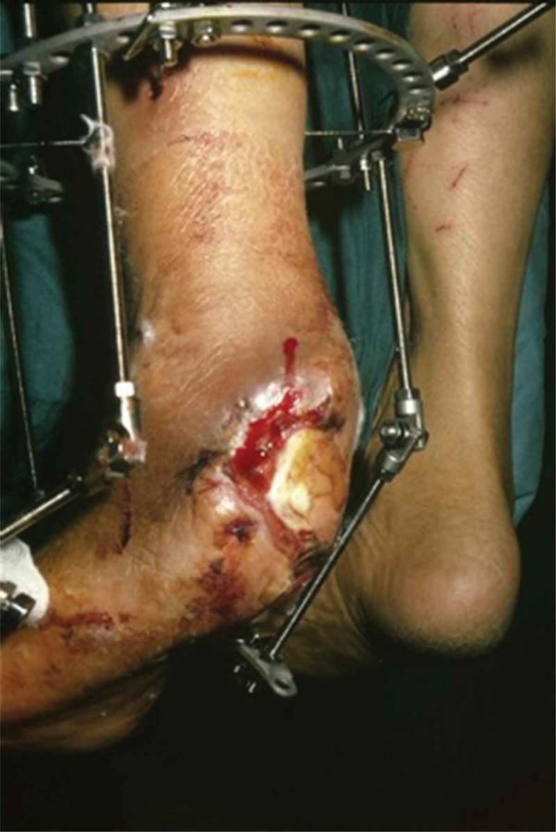 Partial calcanectomy and Ilizarov external fixation may reduce amputation need in severe diabetic calcaneal ulcers.