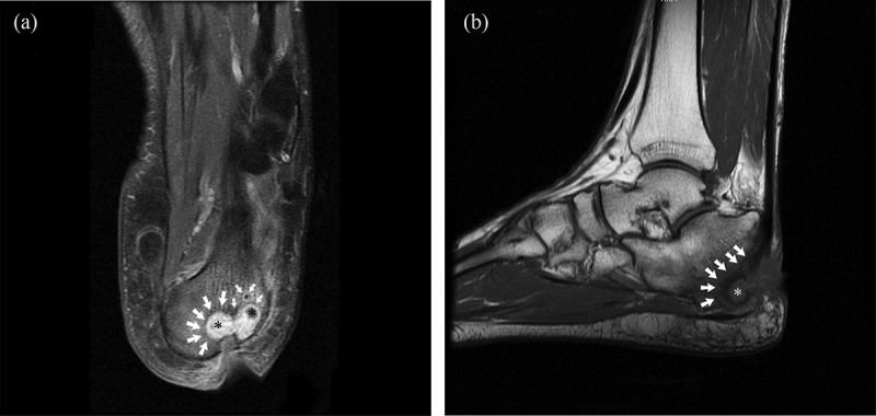 Partial calcanectomy and Ilizarov external fixation may reduce amputation need in severe diabetic calcaneal ulcers.