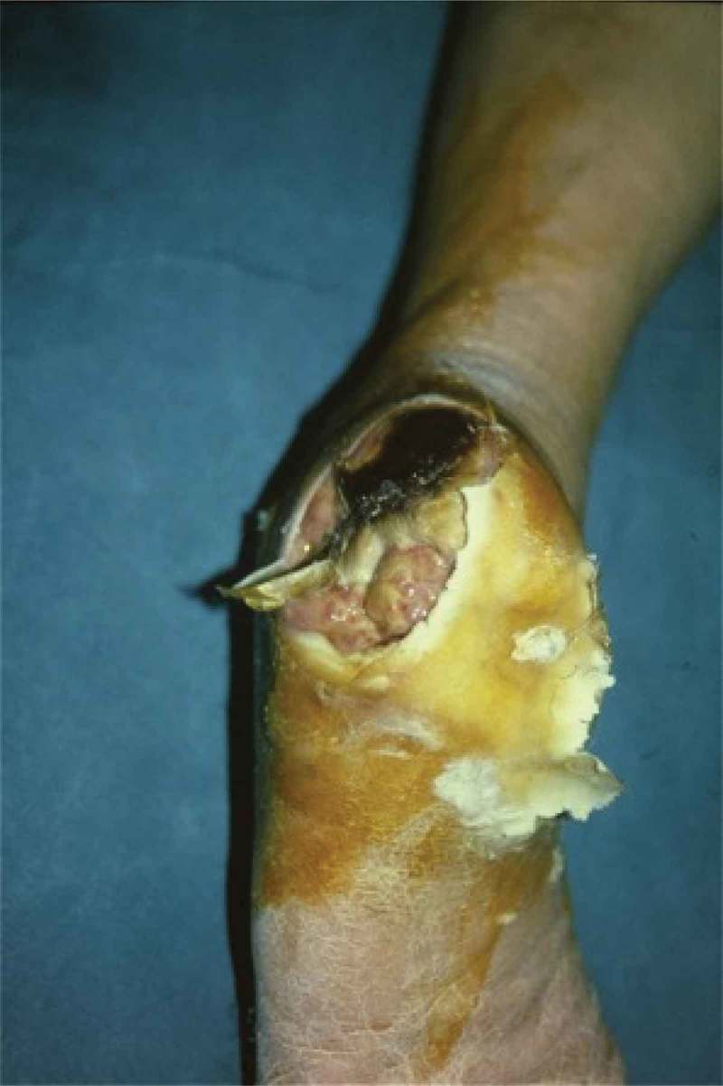 Partial calcanectomy and Ilizarov external fixation may reduce amputation need in severe diabetic calcaneal ulcers.