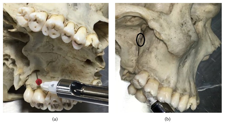 Infraorbital Foramen and Pterygopalatine Fossa Location in Dry Skulls: Anatomical Guidelines for Local Anesthesia.