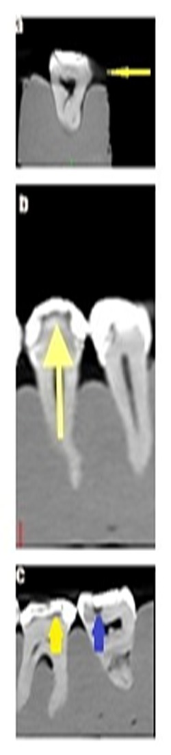 Diagnostic accuracy of cone-beam computed tomography in detecting secondary caries under composite fillings: an in vitro study.