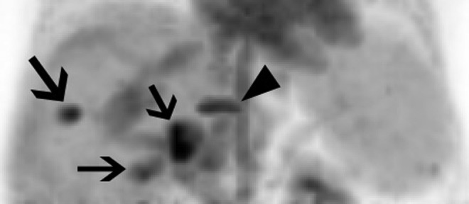 Imaging Hepatocellular Carcinoma With <sup>68</sup>Ga-Citrate PET: First Clinical Experience.