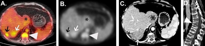 Imaging Hepatocellular Carcinoma With <sup>68</sup>Ga-Citrate PET: First Clinical Experience.