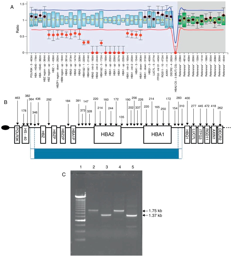 A combination of the -α3.7 and --MEDII alleles causing hemoglobin H disease in a Brazilian patient