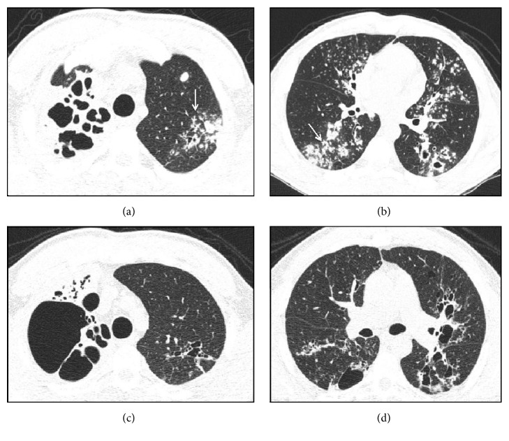 Tomographic Aspects of Advanced Active Pulmonary Tuberculosis and Evaluation of Sequelae following Treatment.