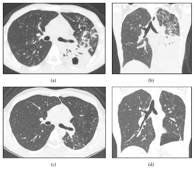 Tomographic Aspects of Advanced Active Pulmonary Tuberculosis and Evaluation of Sequelae following Treatment.