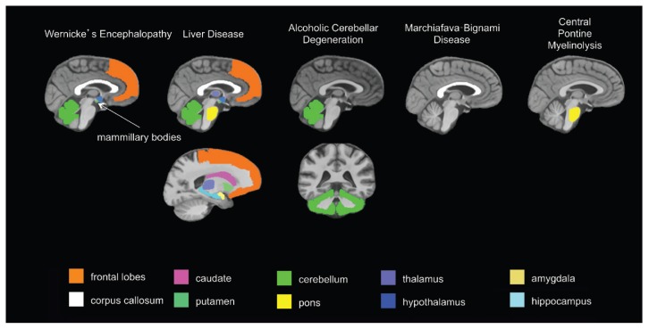 Alcohol's Effects on the Brain: Neuroimaging Results in Humans and Animal Models.