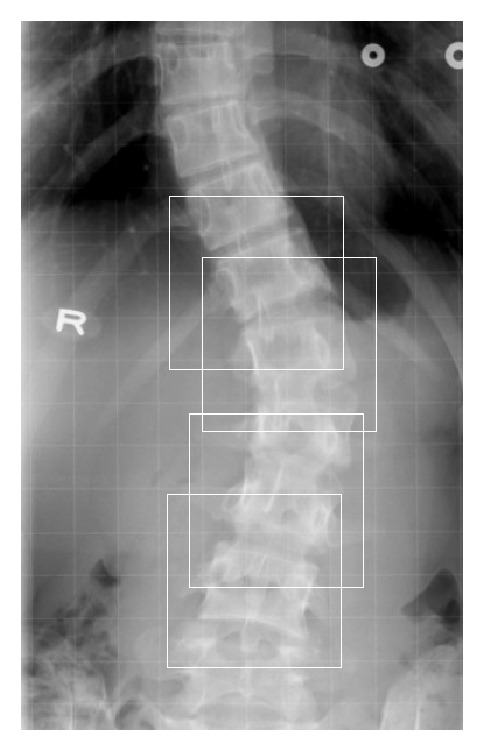 Computer-Aided Cobb Measurement Based on Automatic Detection of Vertebral Slopes Using Deep Neural Network.