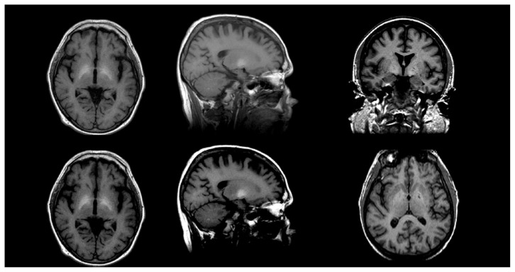 Alcohol's Effects on the Brain: Neuroimaging Results in Humans and Animal Models.