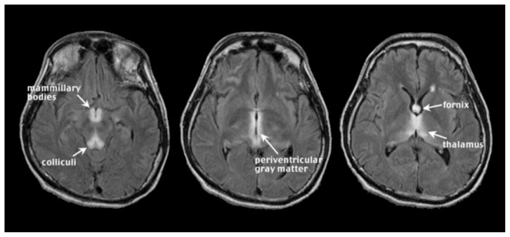 Alcohol's Effects on the Brain: Neuroimaging Results in Humans and Animal Models.