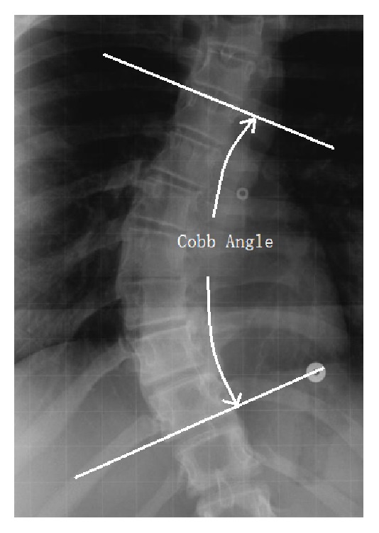 Computer-Aided Cobb Measurement Based on Automatic Detection of Vertebral Slopes Using Deep Neural Network.