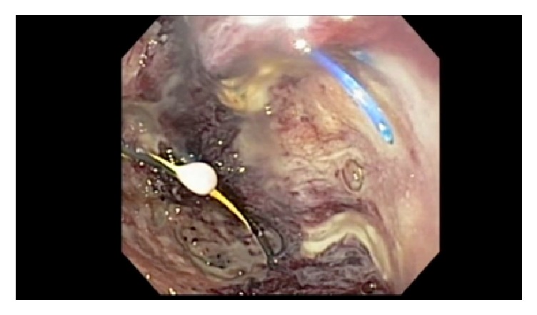 Extended Cystogastrostomy with Hydrogen Peroxide Irrigation Facilitates Endoscopic Pancreatic Necrosectomy.