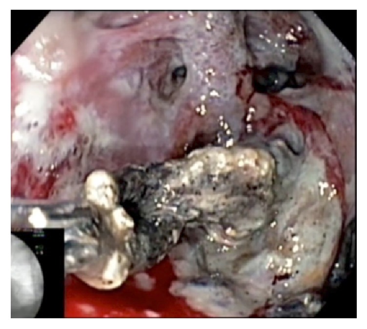 Extended Cystogastrostomy with Hydrogen Peroxide Irrigation Facilitates Endoscopic Pancreatic Necrosectomy.