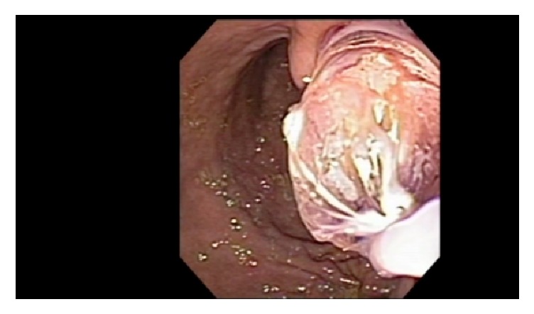 Extended Cystogastrostomy with Hydrogen Peroxide Irrigation Facilitates Endoscopic Pancreatic Necrosectomy.