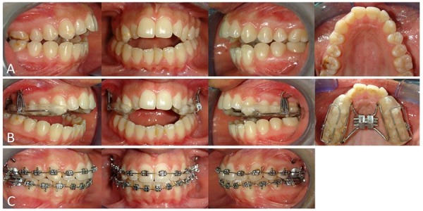 Anterior open-bite treatment by means of zygomatic miniplates: a case report.