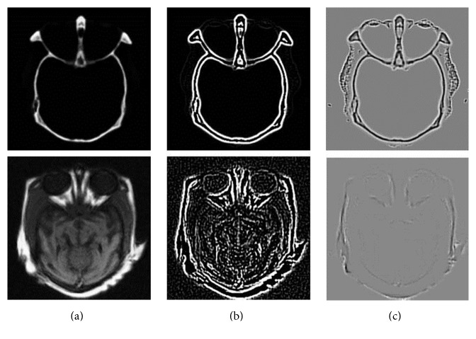 Medical Image Fusion Based on Feature Extraction and Sparse Representation.