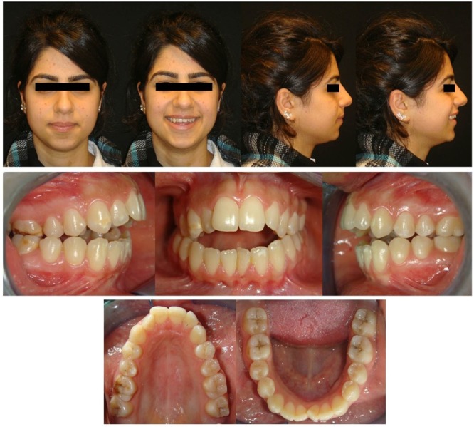 Anterior open-bite treatment by means of zygomatic miniplates: a case report.