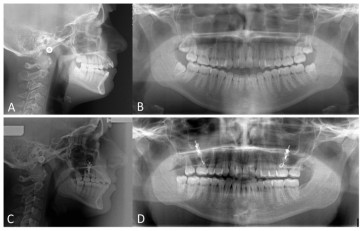 Anterior open-bite treatment by means of zygomatic miniplates: a case report.