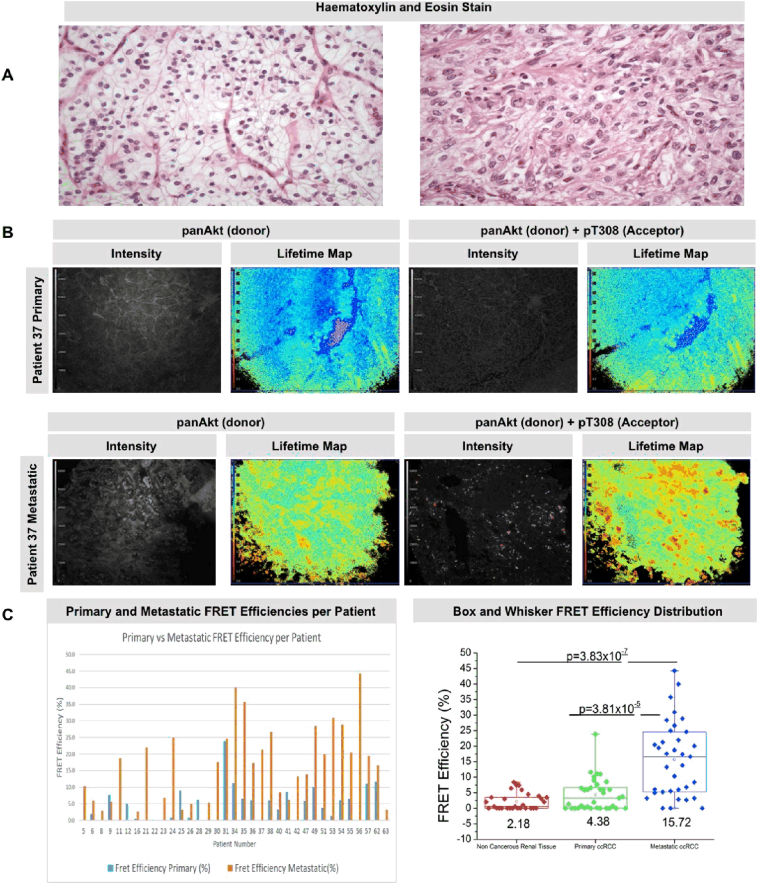 Time resolved amplified FRET identifies protein kinase B activation state as a marker for poor prognosis in clear cell renal cell carcinoma