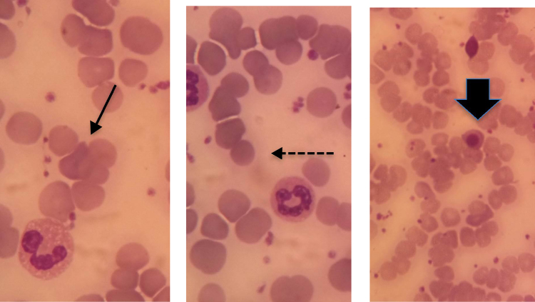 Passenger lymphocyte syndrome in liver transplantation