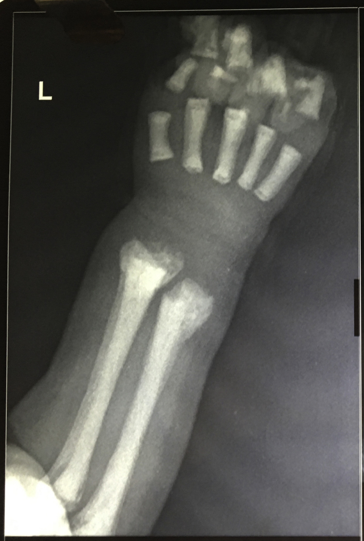 Osteopetrosis in twin infants mimicking leukemia