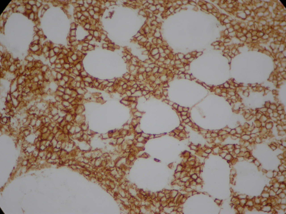 Autoimmune hemolytic anemia and hyperglobulinemia leading to the diagnosis of multiple myeloma