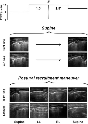 Postural lung recruitment assessed by lung ultrasound in mechanically ventilated children.