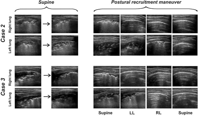 Postural lung recruitment assessed by lung ultrasound in mechanically ventilated children.