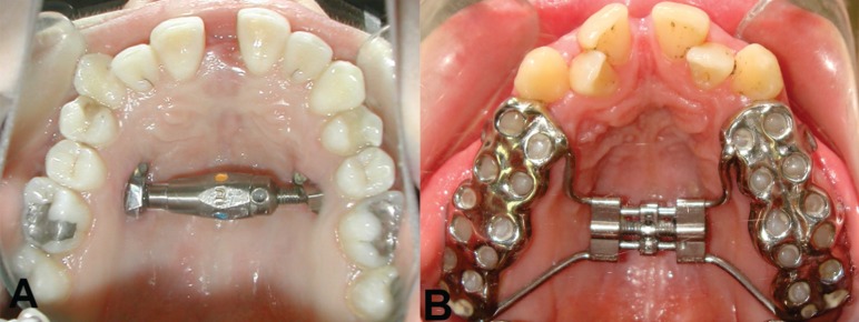 The effects of maxillary expansion on the soft tissue facial profile.