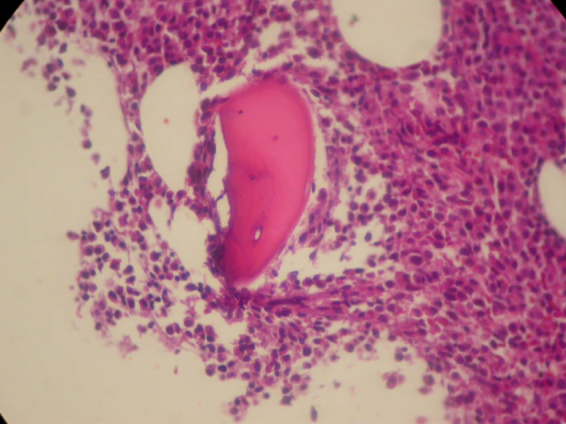 Autoimmune hemolytic anemia and hyperglobulinemia leading to the diagnosis of multiple myeloma