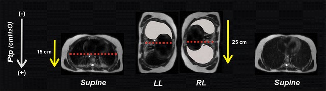 Postural lung recruitment assessed by lung ultrasound in mechanically ventilated children.