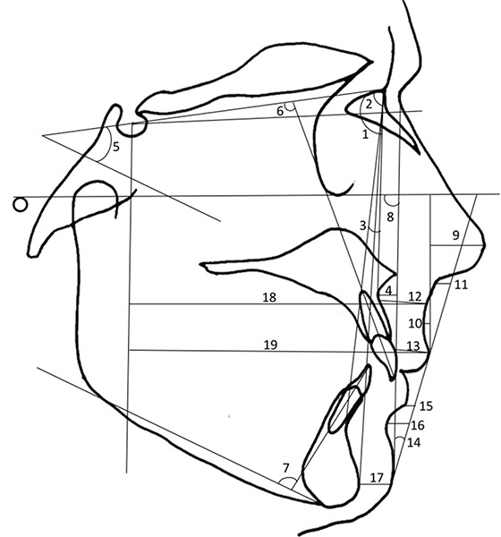 The effects of maxillary expansion on the soft tissue facial profile.