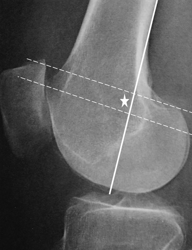 Anatomic Double-Bundle Medial Patellofemoral Ligament Reconstruction with Autologous Semitendinosus: Aperture Fixation Both at the Femur and the Patella.