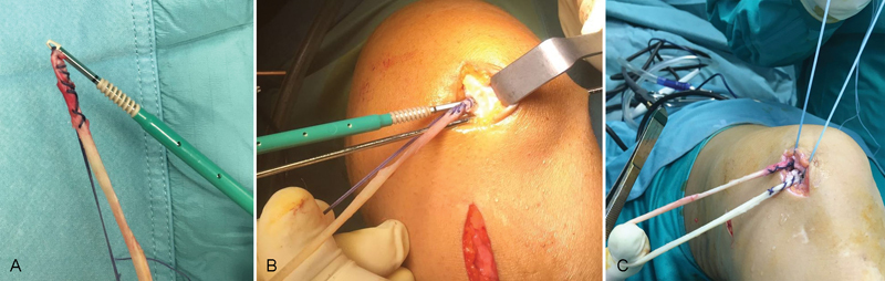 Anatomic Double-Bundle Medial Patellofemoral Ligament Reconstruction with Autologous Semitendinosus: Aperture Fixation Both at the Femur and the Patella.