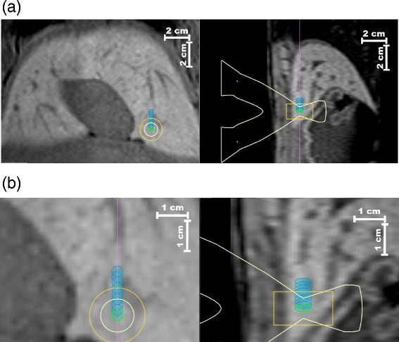 A framework for continuous target tracking during MR-guided high intensity focused ultrasound thermal ablations in the abdomen.