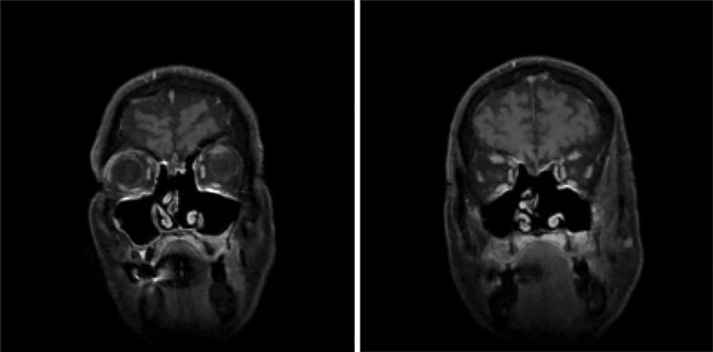 Long-term follow-up of a patient with malignant transformation of inverted papilloma into sinonasal undifferentiated carcinoma.