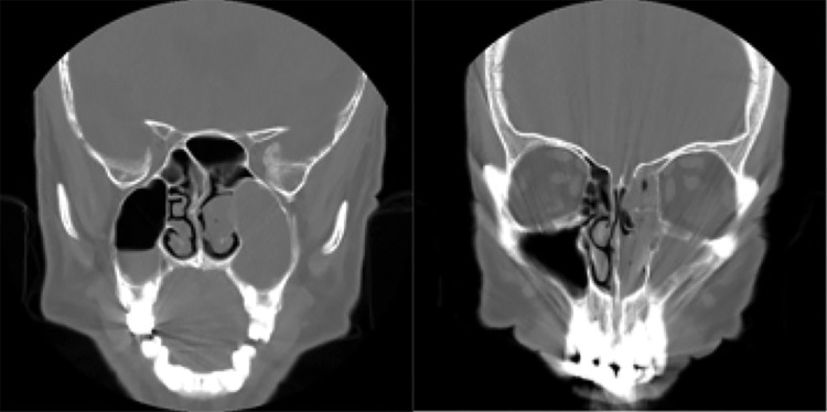 Long-term follow-up of a patient with malignant transformation of inverted papilloma into sinonasal undifferentiated carcinoma.