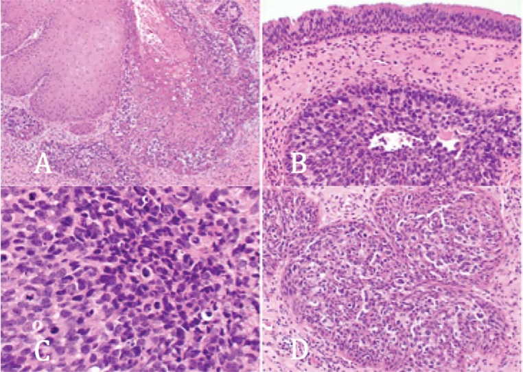 Long-term follow-up of a patient with malignant transformation of inverted papilloma into sinonasal undifferentiated carcinoma.