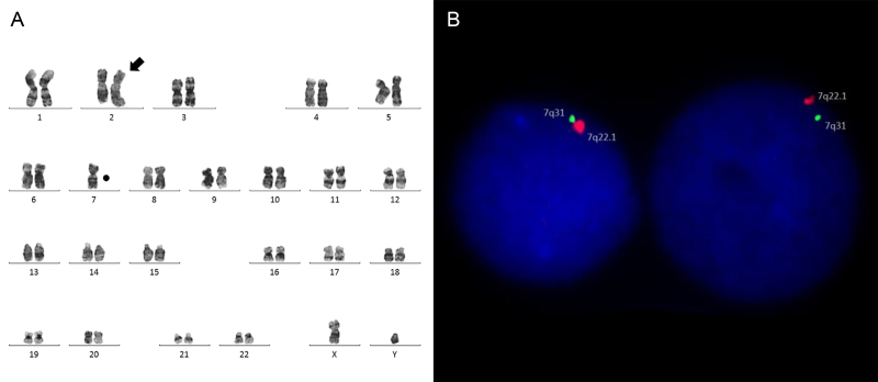 Molecular genetic techniques for gains and losses of genomic material in a case of acute myeloid leukemia