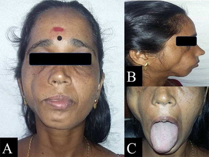 Clinical and radiographic features of parry-romberg syndrome.