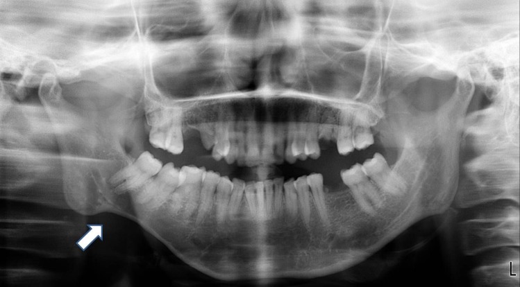 Clinical and radiographic features of parry-romberg syndrome.