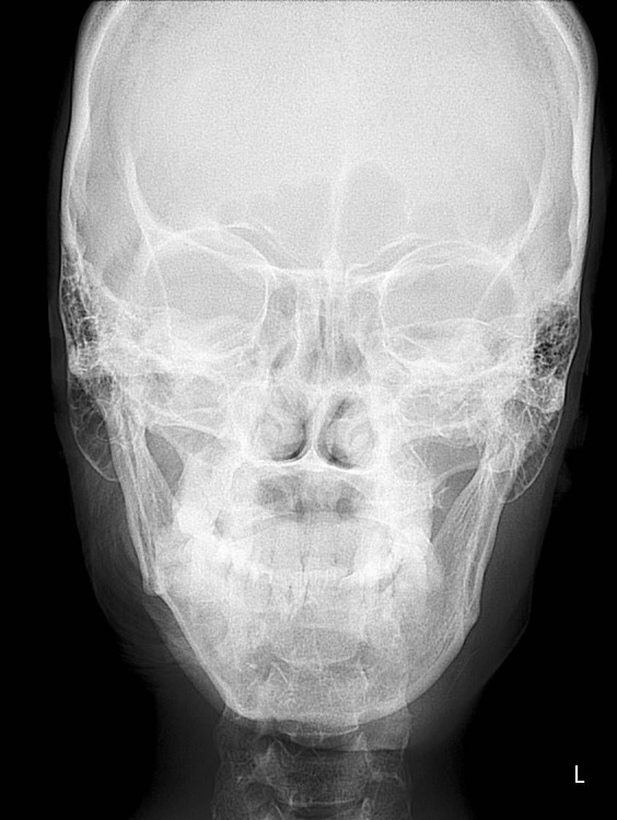 Clinical and radiographic features of parry-romberg syndrome.