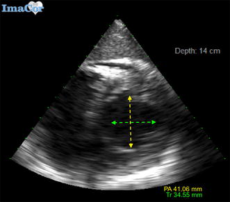 The relationship between single and two-dimensional indices of left ventricular size using hemodynamic transesophageal echocardiography in trauma and burn patients.