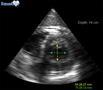 The relationship between single and two-dimensional indices of left ventricular size using hemodynamic transesophageal echocardiography in trauma and burn patients.